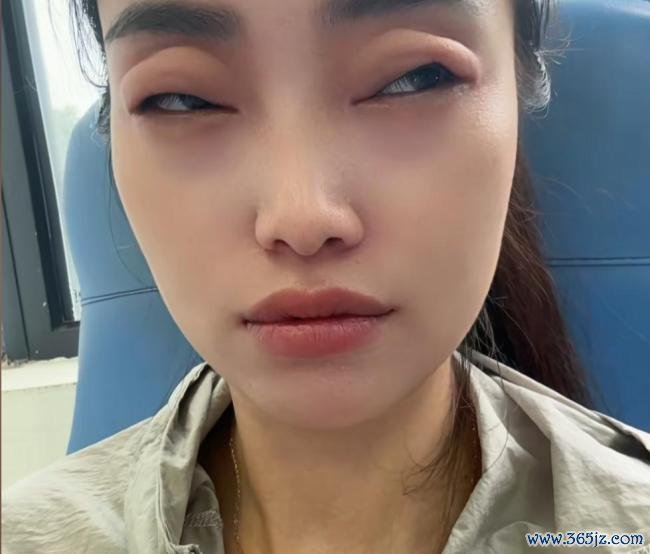 2颗杨梅下肚 女子眼睛差点看不见了