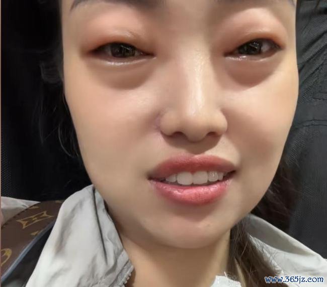 2颗杨梅下肚 女子眼睛差点看不见了 薄情过敏案例警示